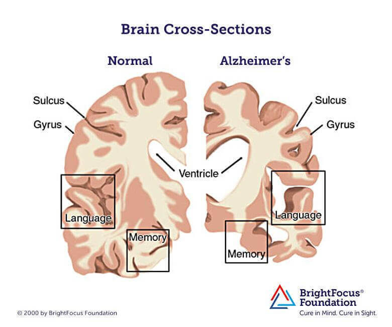 Acetylcholine And Alzheimer's Disease